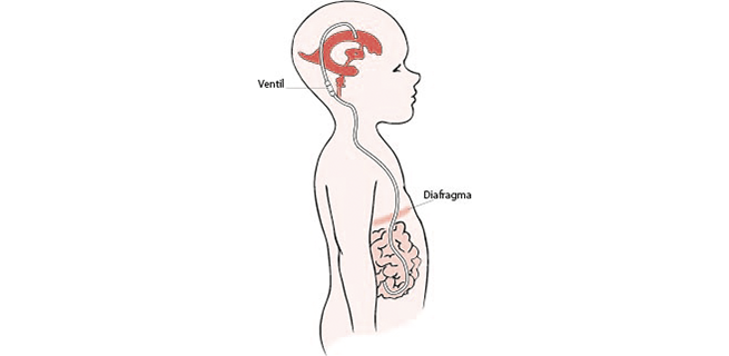 Illustration som visar hydrocefalus