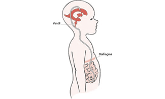 Illustration som visar hydrocefalus