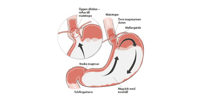 Illustration som visar magsäck och tarm
