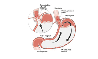 Illustration som visar magsäck och tarm
